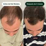 Serum Anticaída